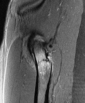Figure 5 for case Calcar stress fracture ( RID4695 )